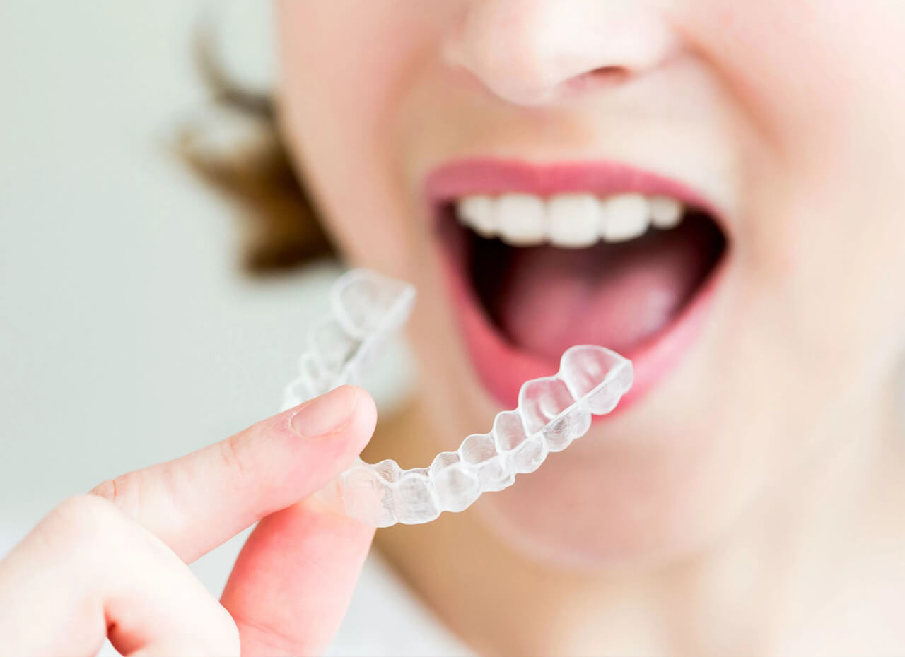 How to Properly Care For Your Invisalign Trays: Bucktown Wicker Park  Dental: General and Cosmetic Dentistry