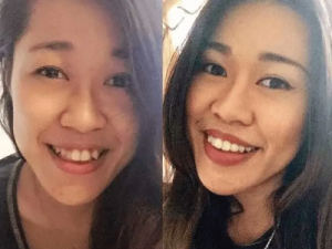 Invisalign Centre Dentaire Saint-Lambert Inc Dentistes St Lambert Dentist Dental Centre