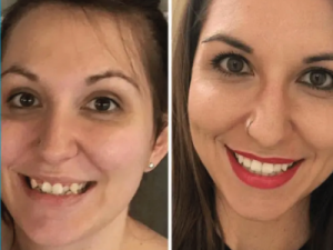 Invisalign Centre Dentaire Saint-Lambert Inc Dentistes St Lambert Dentist Dental Centre