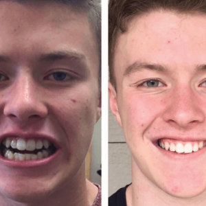 Invisalign Centre Dentaire Saint-Lambert Inc Dentistes St Lambert Dentist Dental Centre