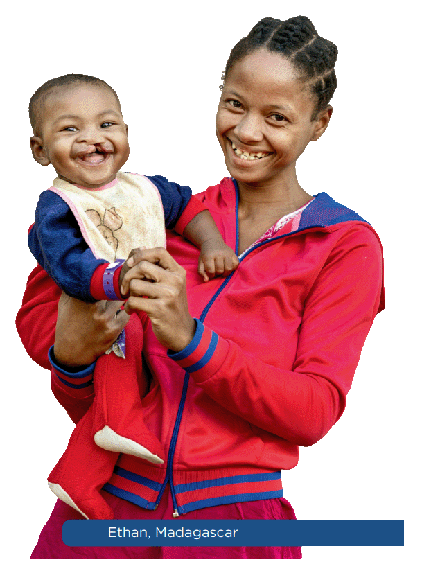 Une mère et son enfant — Operation Smile
